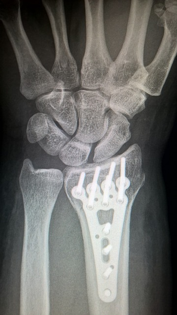 broken bones from t-bone car accidents
